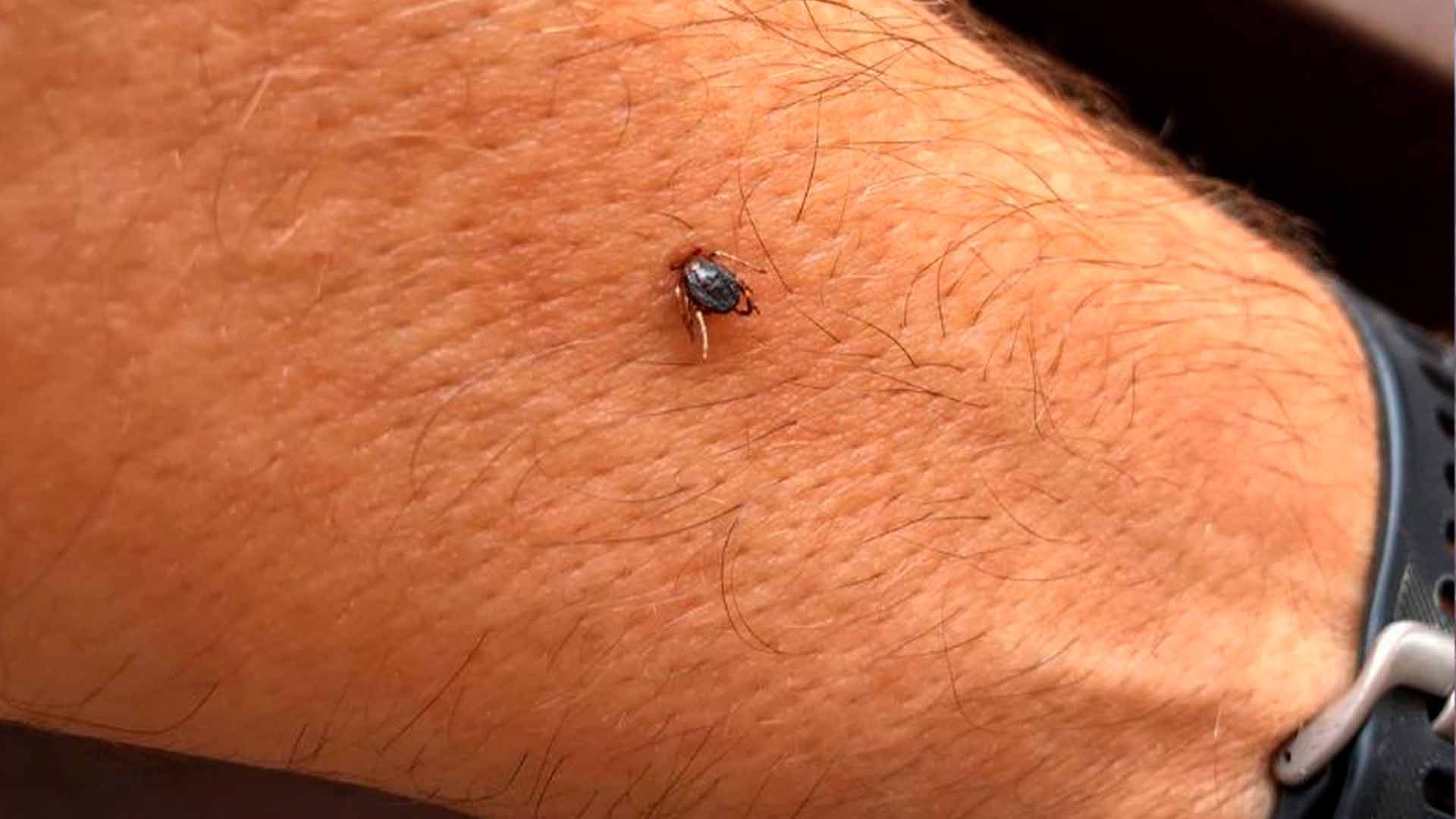 Una garrapata adherida a la piel velluda de un brazo.